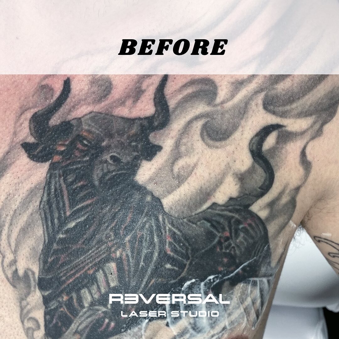 Results after just 3 sessions! ⚡️

Work in progress. We just did a 4th session on this tattoo to further lighten it to get it ready for a coverup. We always start with treating black first before treating colors to protect the skin.

A piece this siz