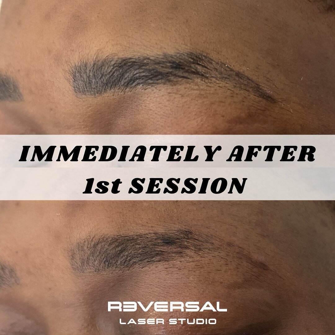 Can we work on darker skin types?

Yes we can! This is one of the things we love about the PicoWay. It is safe for ALL skin types.

Check out the results immediately after just one session! The pigment will continue to fade over the next couple of mo