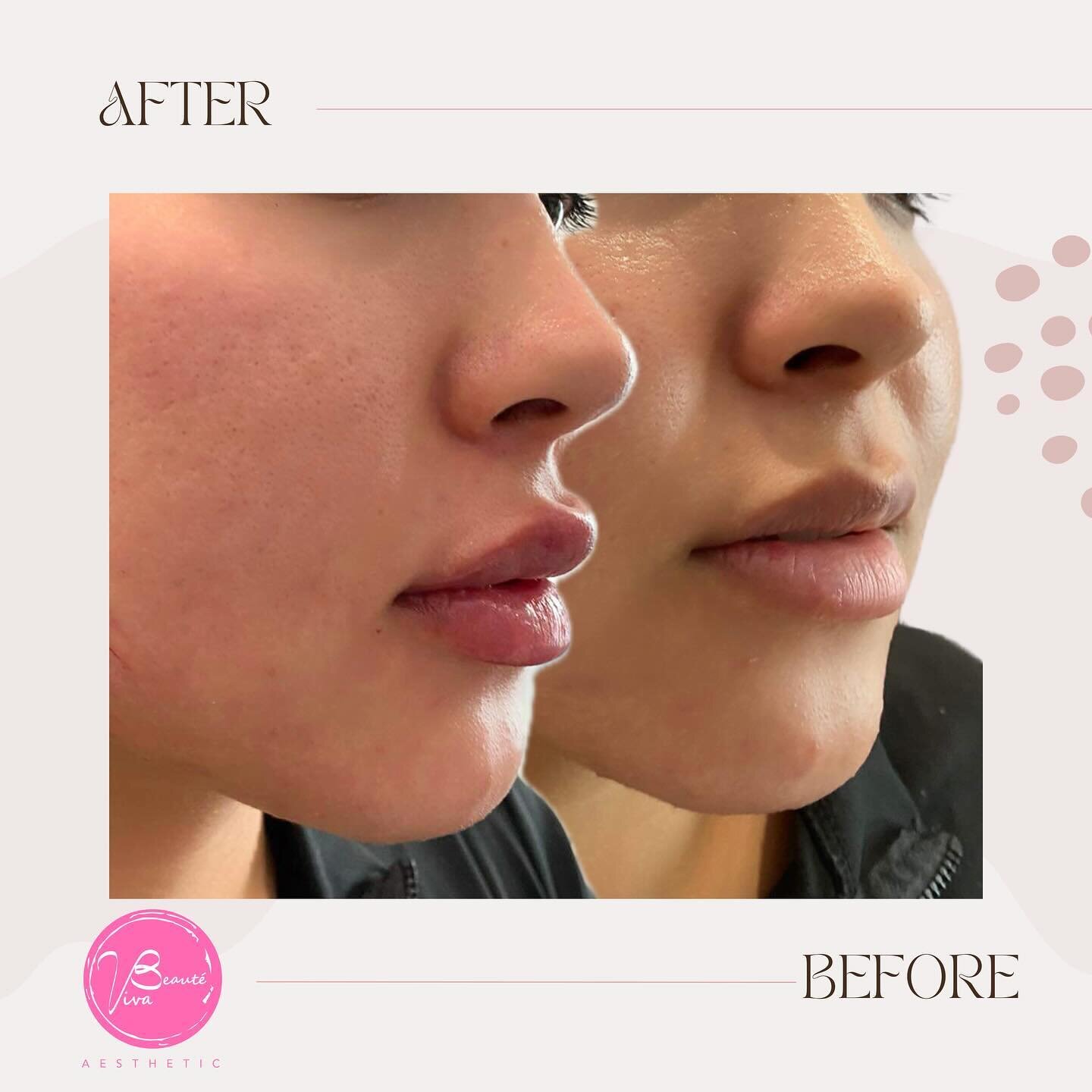 👄 Addressing the client's desire for fuller lips and correction of the downturned corners of the mouth (curling oral commissure). 

💫 Treatment: Medium Lips Filler
💉 Quantity: 1ml x dermal filler
⏰ Duration: 1 hr (includes numbing cream)
🙅🏼&zwj;