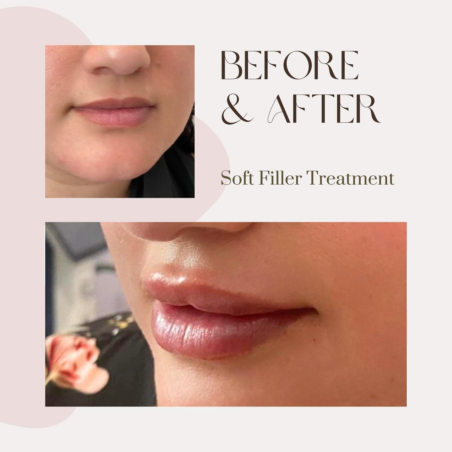 Check out another stunning Before and After photos showcasing the incredible transformation of our client with our Soft Lips Filler treatment! 💋

✨ Treatment: Soft Lips Filler
💉 Quantity: 1ml x dermal filler
⏰ Duration: 1 hr (includes numbing cream