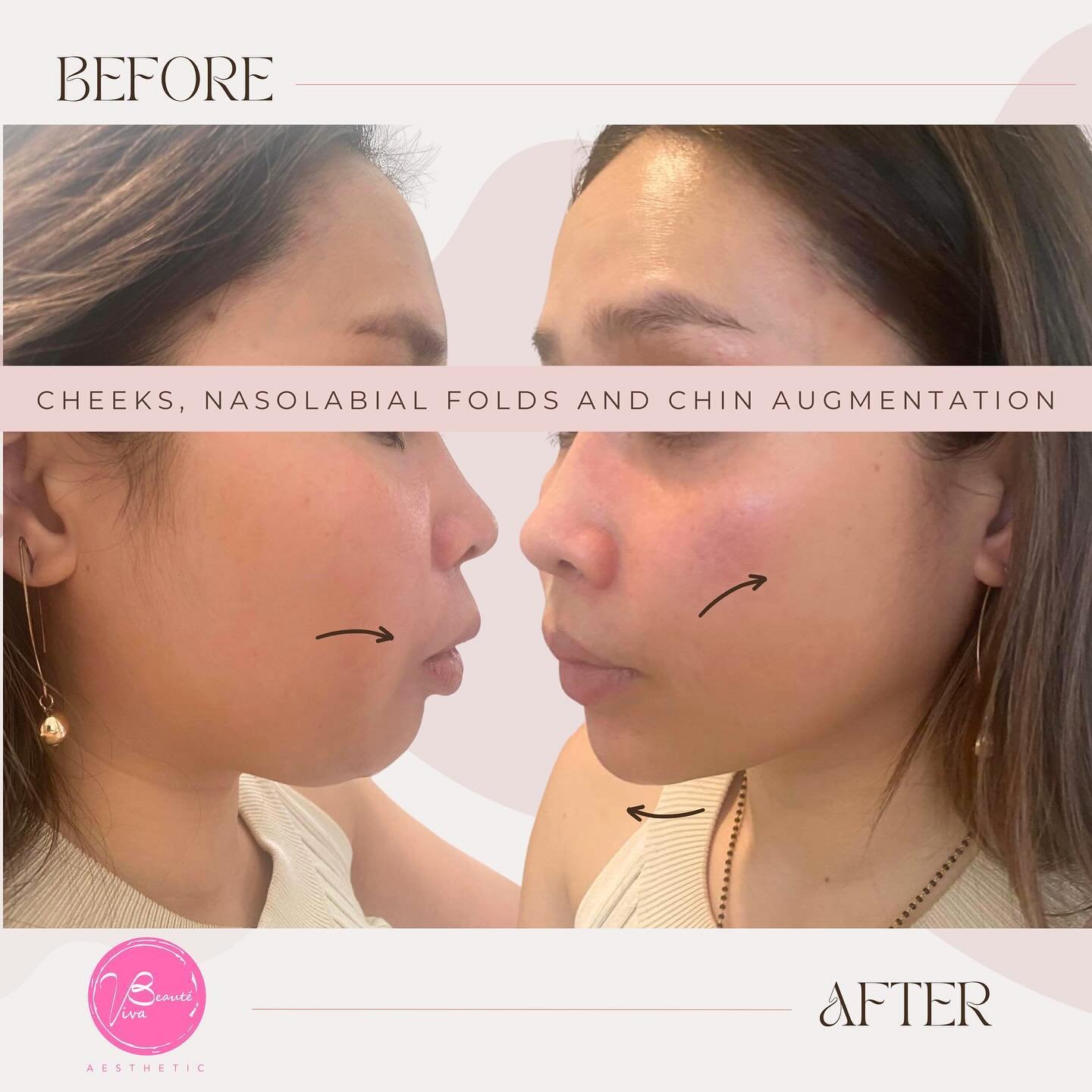 🌟 Transformation Alert! 🌟
Swipe left to see her incredible Before and After photos! 👈🏼

Our lovely client, who felt self-conscious about her rounded, chubby &ldquo;baby face,&rdquo; sought a more defined look. With our V-lift Technique, we sculpt