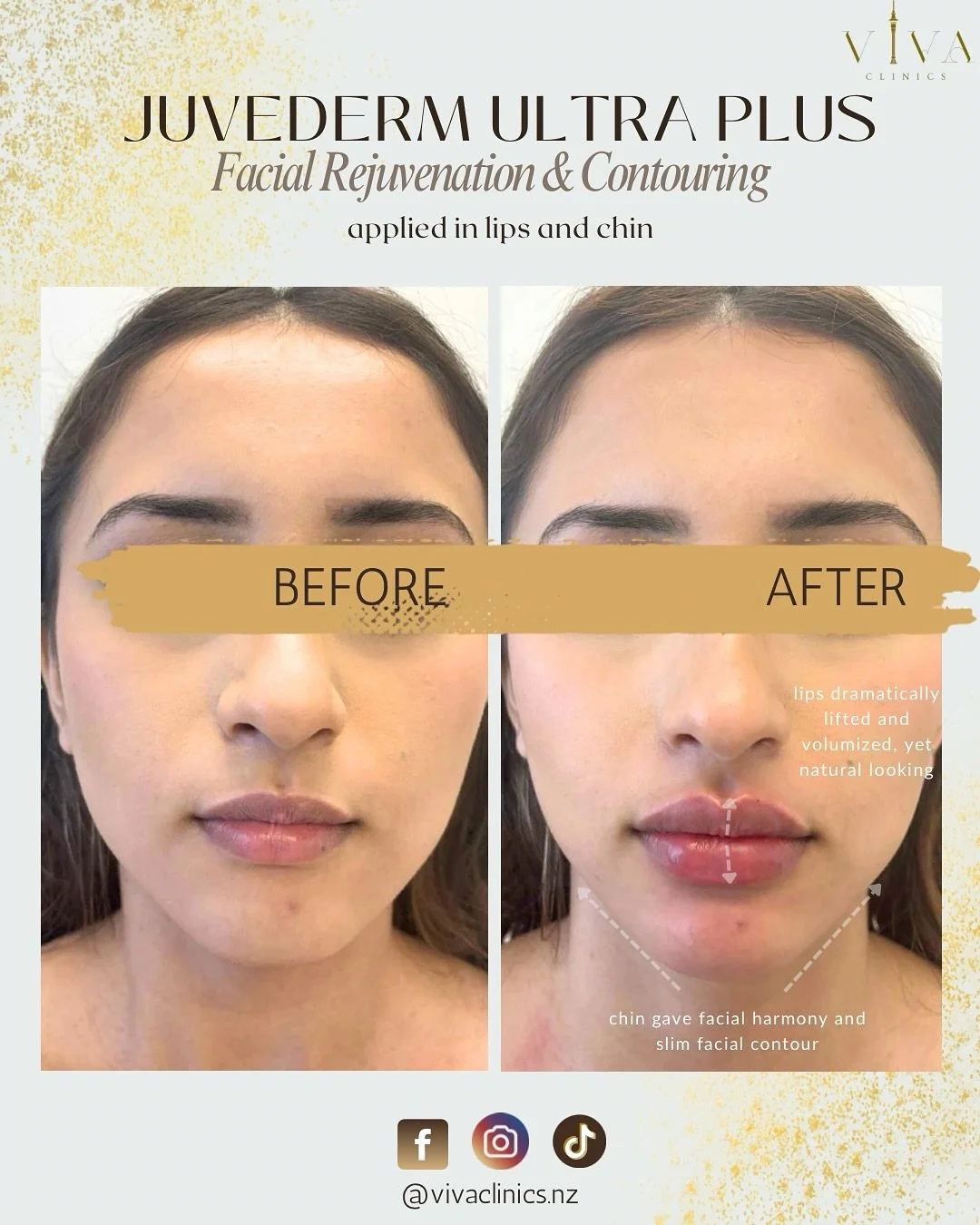 𝐂𝐥𝐢𝐞𝐧𝐭 𝐒𝐩𝐨𝐭𝐥𝐢𝐠𝐡𝐭: 𝐉𝐮𝐯&eacute;𝐝𝐞𝐫𝐦 𝐔𝐥𝐭𝐫𝐚 𝐏𝐥𝐮𝐬
Juvederm is a thick hyaluronic acid injectable filler and using advanced lip and chin contouring techniques, we created:
&bull; Fuller, lifted lips
&bull; Improved chin proje