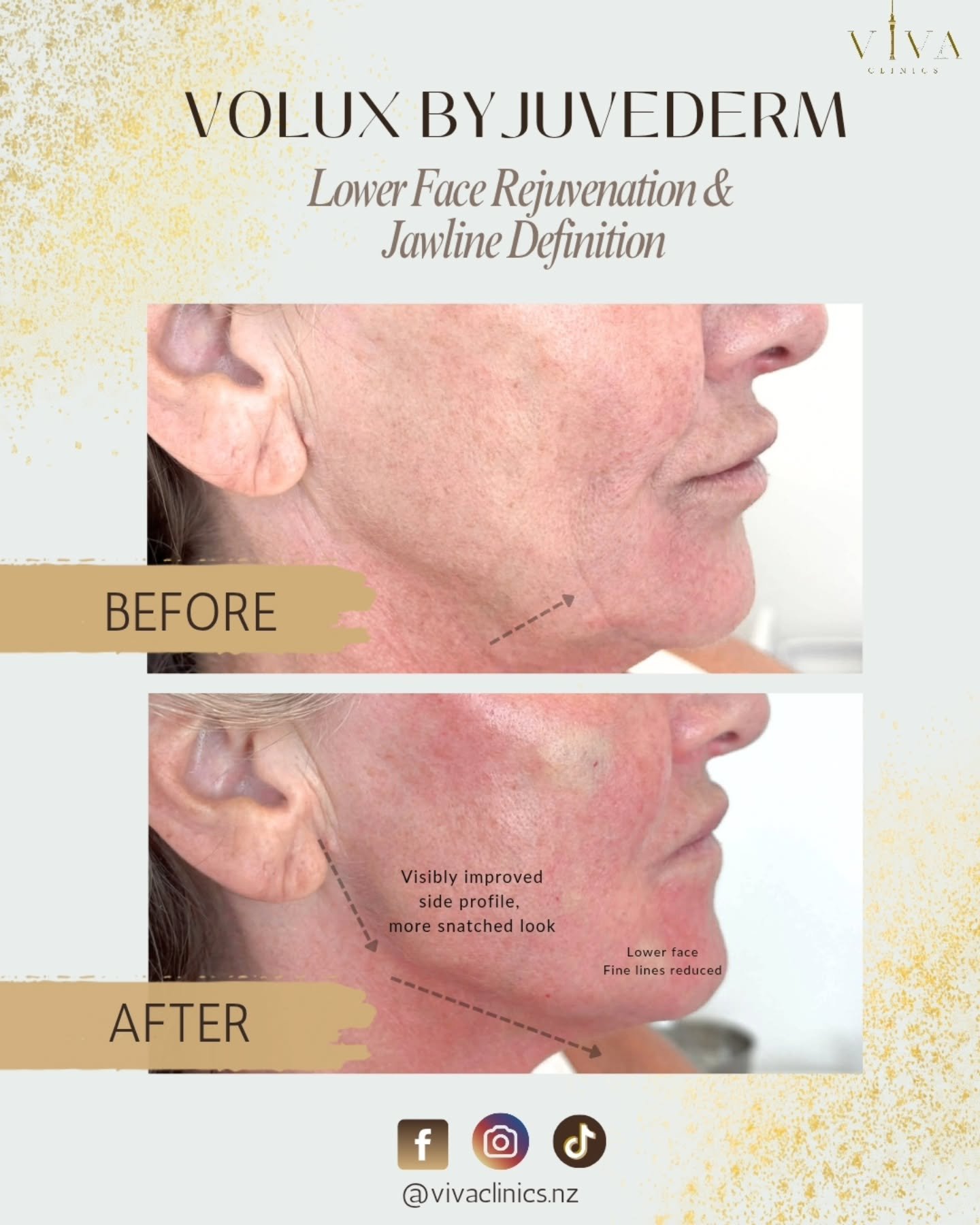 𝙇𝙤𝙬𝙚𝙧 𝙁𝙖𝙘𝙚 𝙍𝙚𝙟𝙪𝙫𝙚𝙣𝙖𝙩𝙞𝙤𝙣 𝙬𝙞𝙩𝙝 𝙑𝙤𝙡𝙪𝙭 𝙗𝙮 𝙅𝙪𝙫𝙚𝙙𝙚𝙧𝙢

A beautifully contoured jawline and smoother lower face can restore balance and structure to the profile.
This before &amp; after shows visible jawline definition