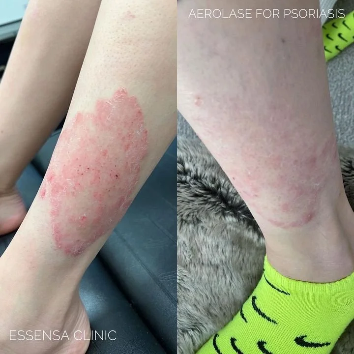 Psoriasis - Essensa Clinic .jpeg