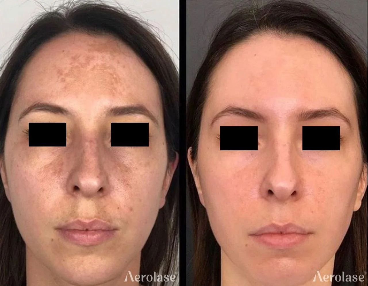 Melasma (Face) - 1 Treatment - Avanti Aesthetic Academy.jpg