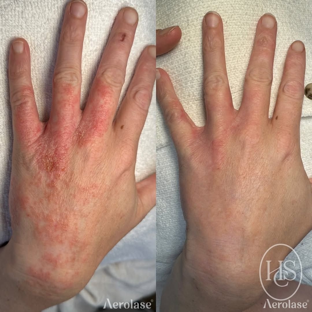Psoriasis (Hands) - Holistic Skin Co .jpg