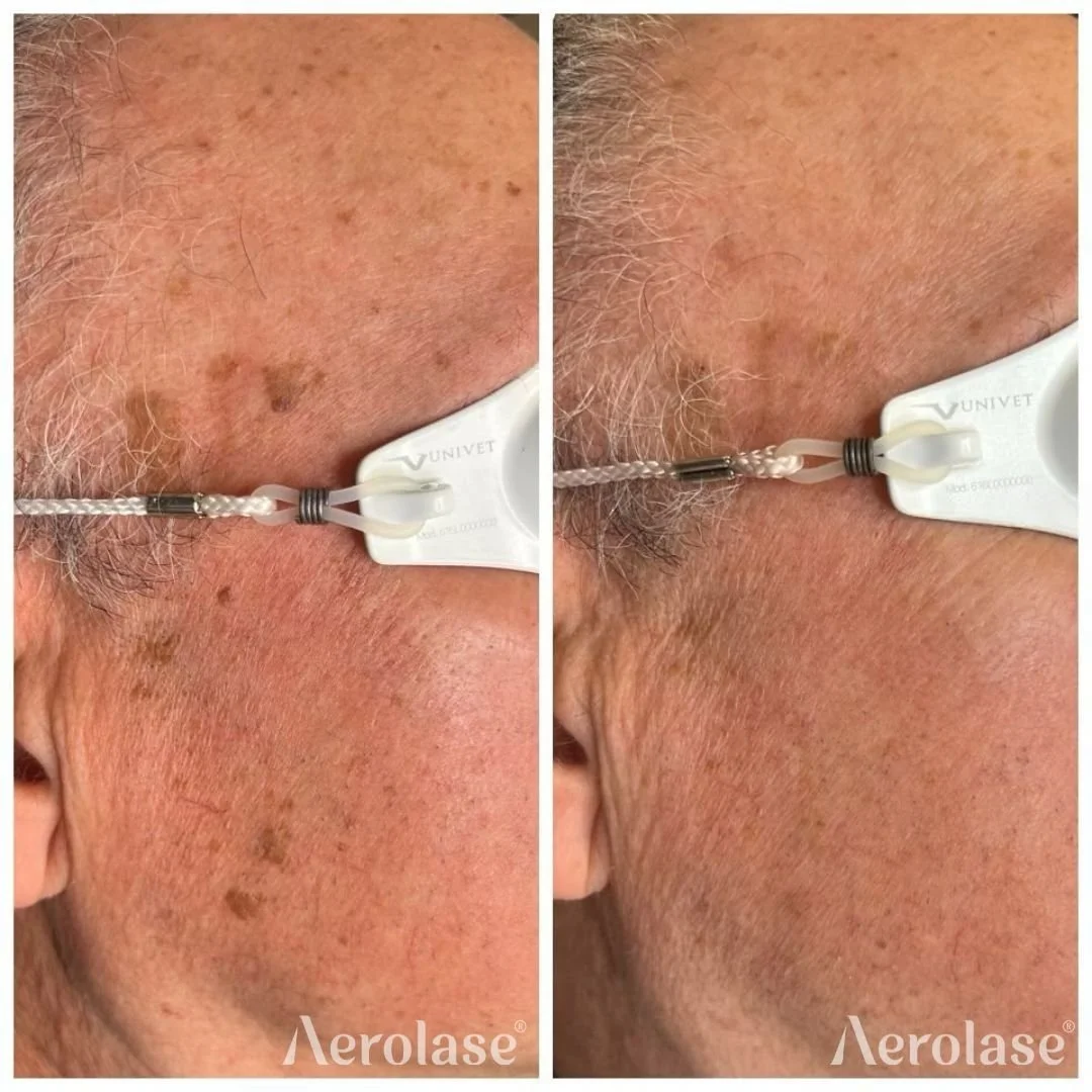 Pigment  Sun Damage - Luxe PG Esthetics .jpg
