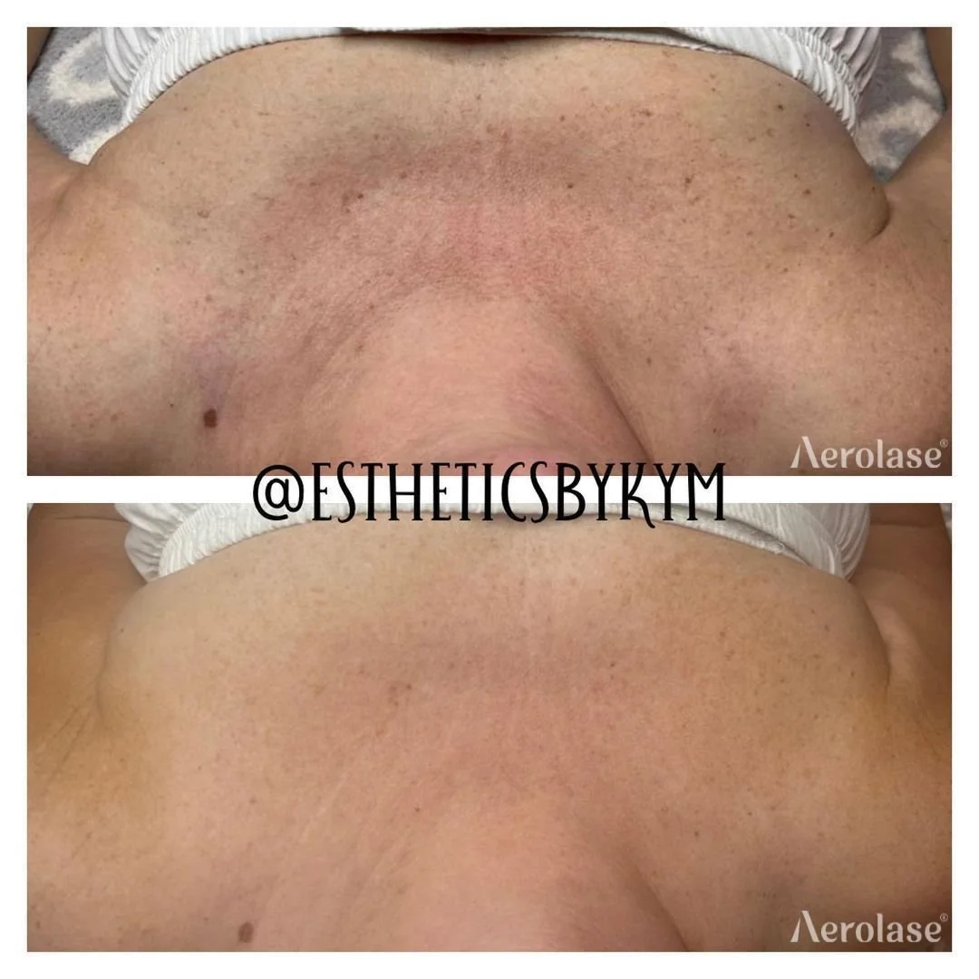 Hyperpigmentation - 4 Treatments - Esthetics By Kym.jpg