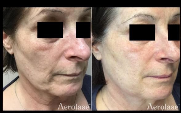 Skin Rejuvenation (Face) .jpg