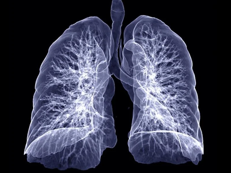 X-Ray image of human lungs