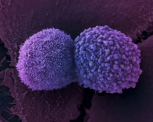 Photograph of two malignant cancer cells that shows their irregular shape. Taken with an electron microscope.