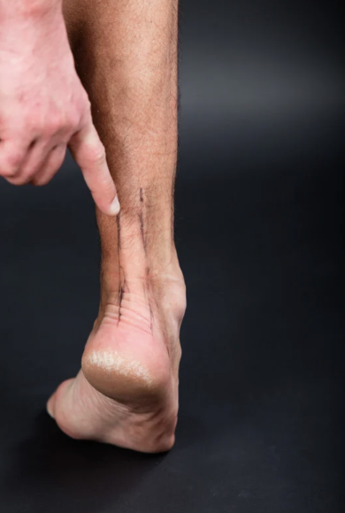World Cup Spotlight: Achilles Injuries - Soccers Silent Threat