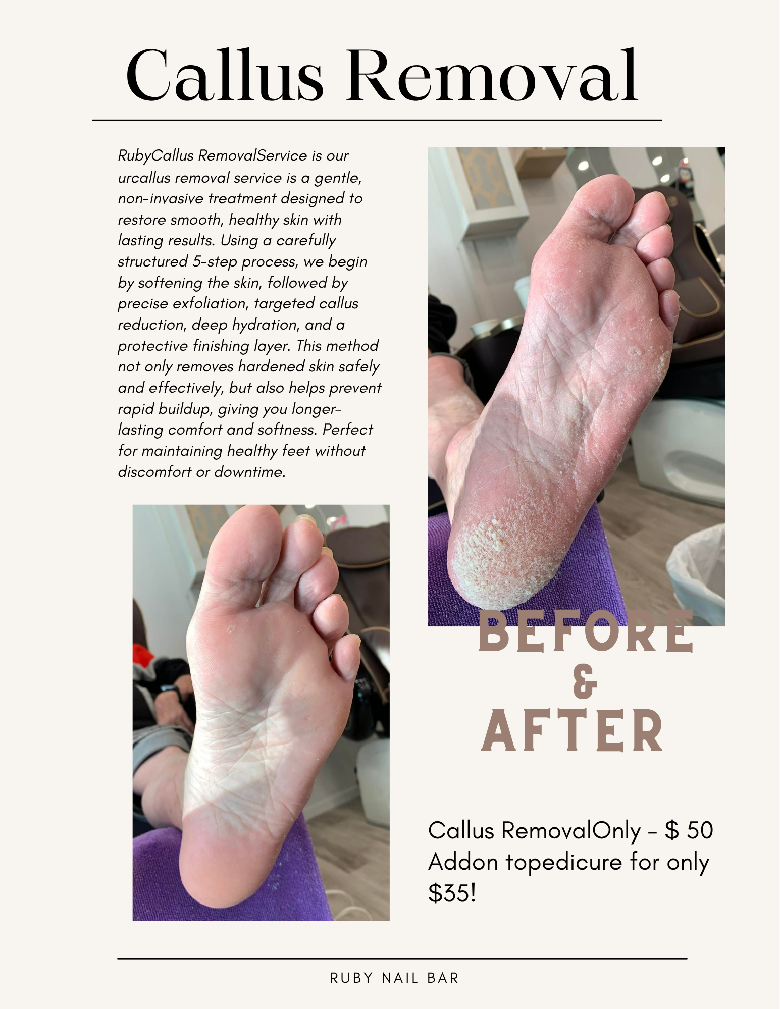 Callus Removal Explained How To Avchieve Smooth Healthy Feet