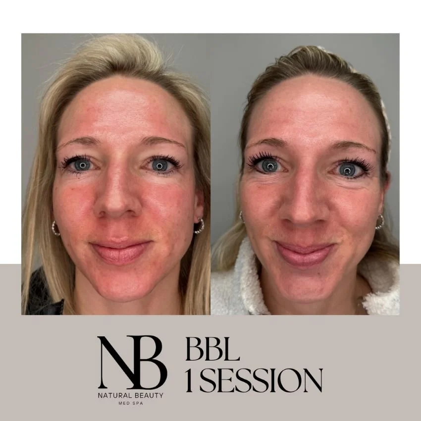25% Off BBL Light Therapy Treatments