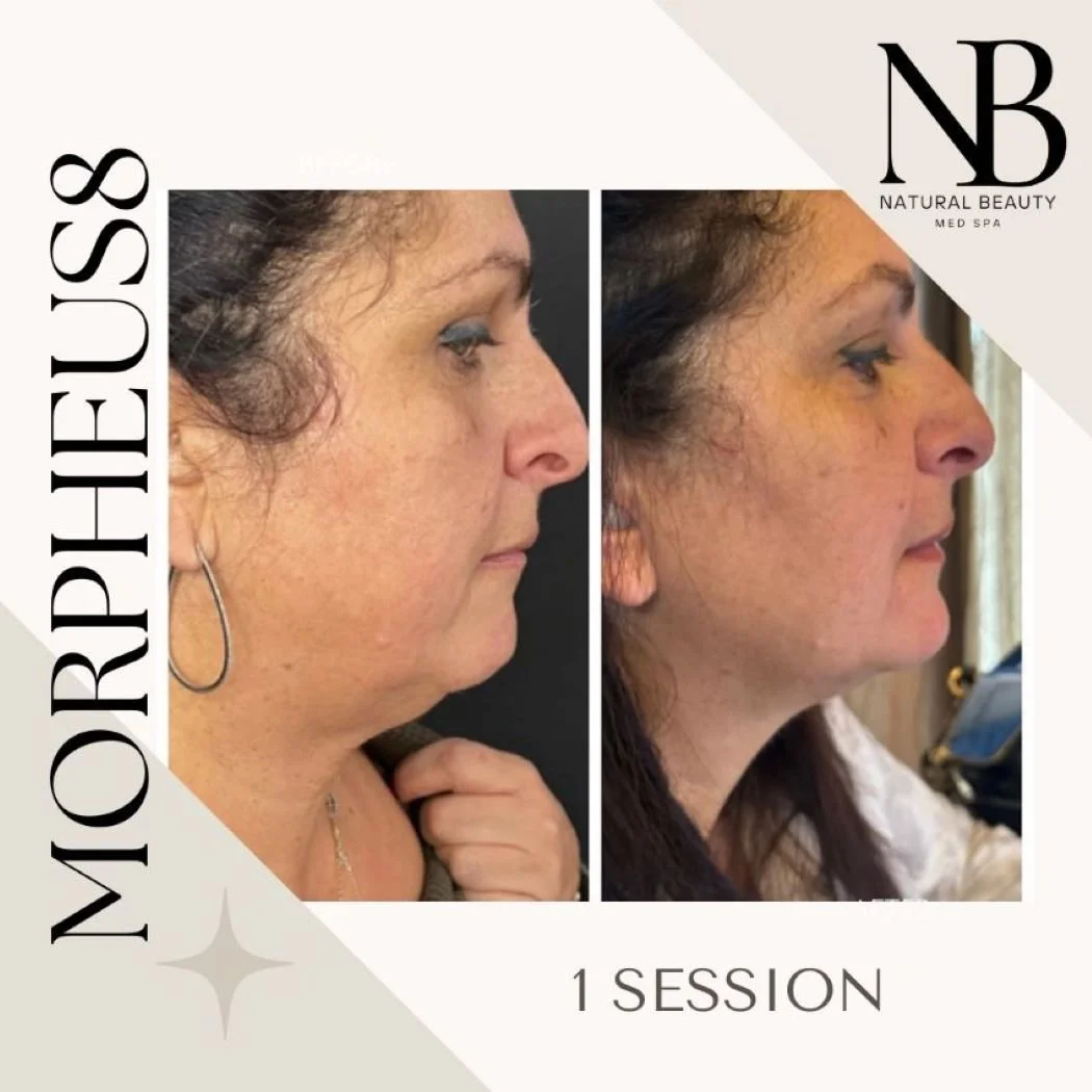 25% Off Morpheus8 Treatment