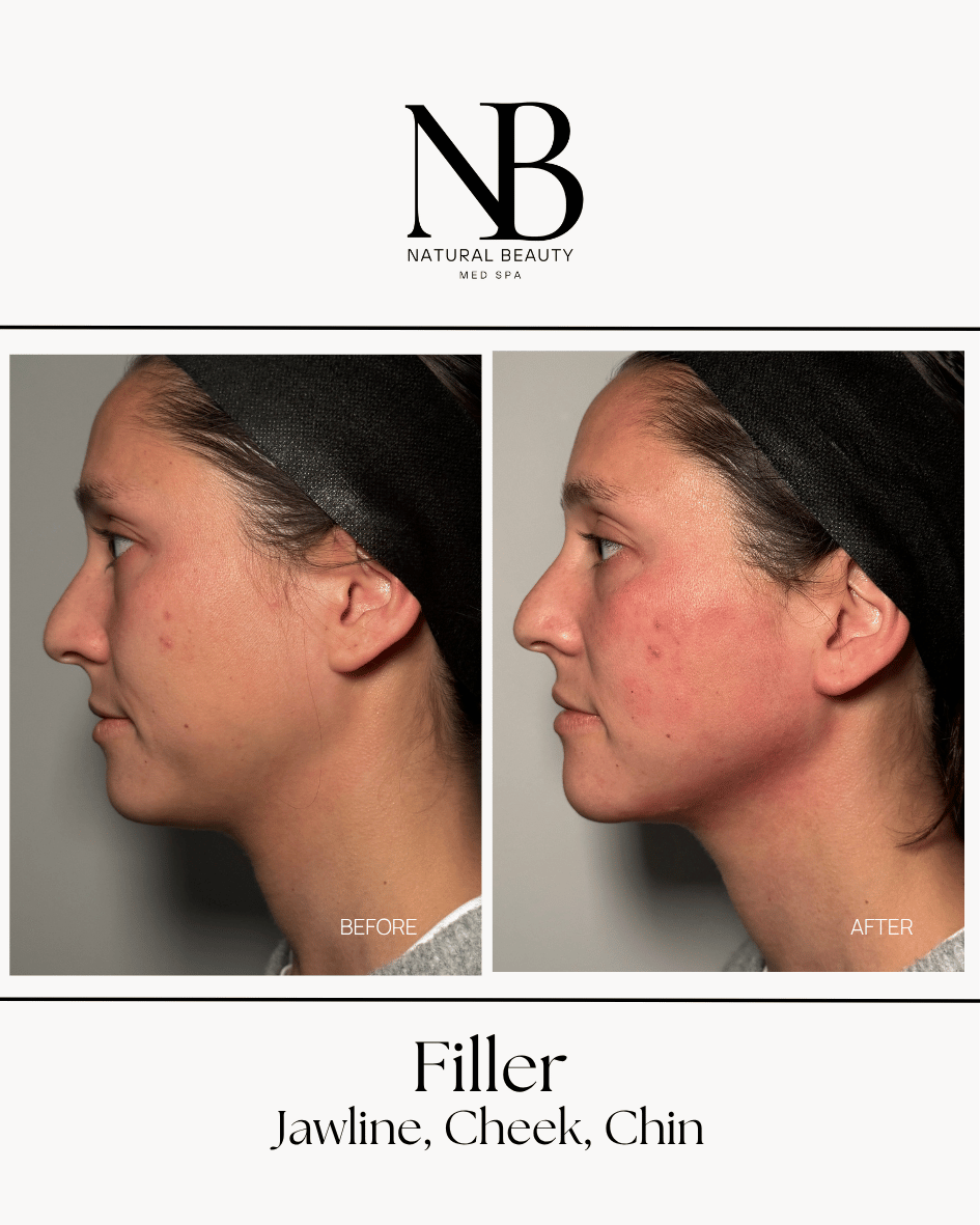Dermal filler results at The Natural Beauty Med Spa in Huntington, Long Island