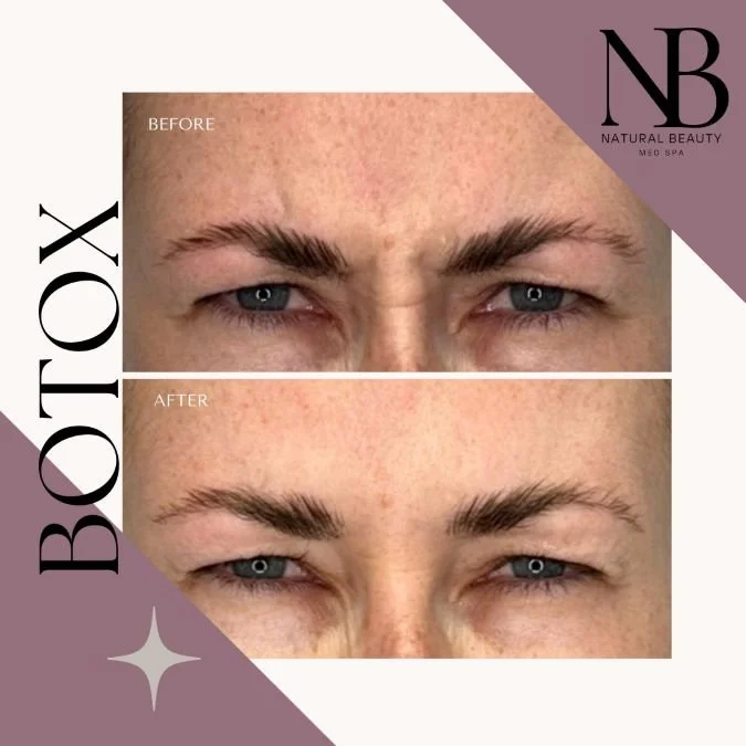 Botox Long Island