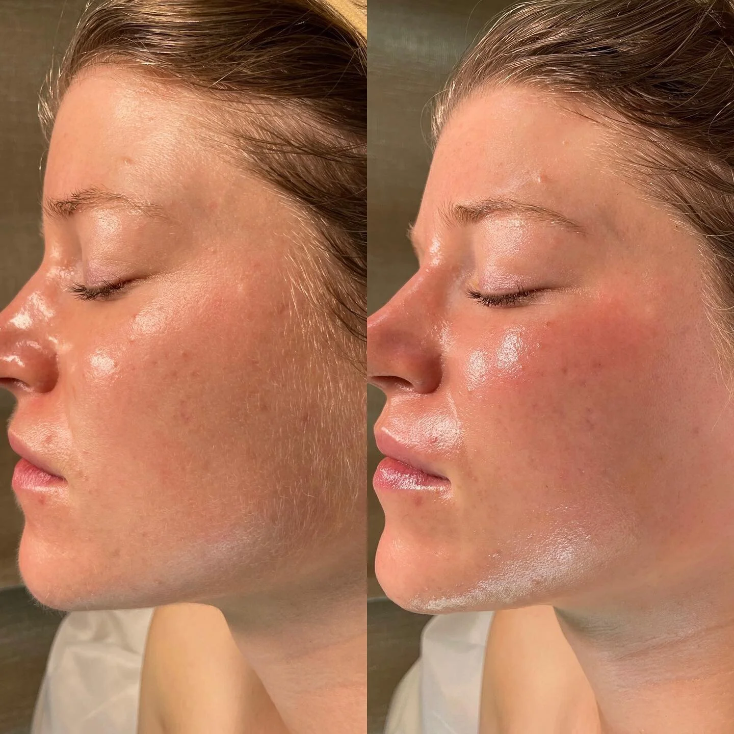 Swipe to see more of this amazing transformation 🤩

#dermaplaning #dermaplane #soloesthetician #montereyfacials #pacificgrovefacials #montereybayfacials #pebblebeachfacialist #beforeandafter #skintransformation #healthyskin