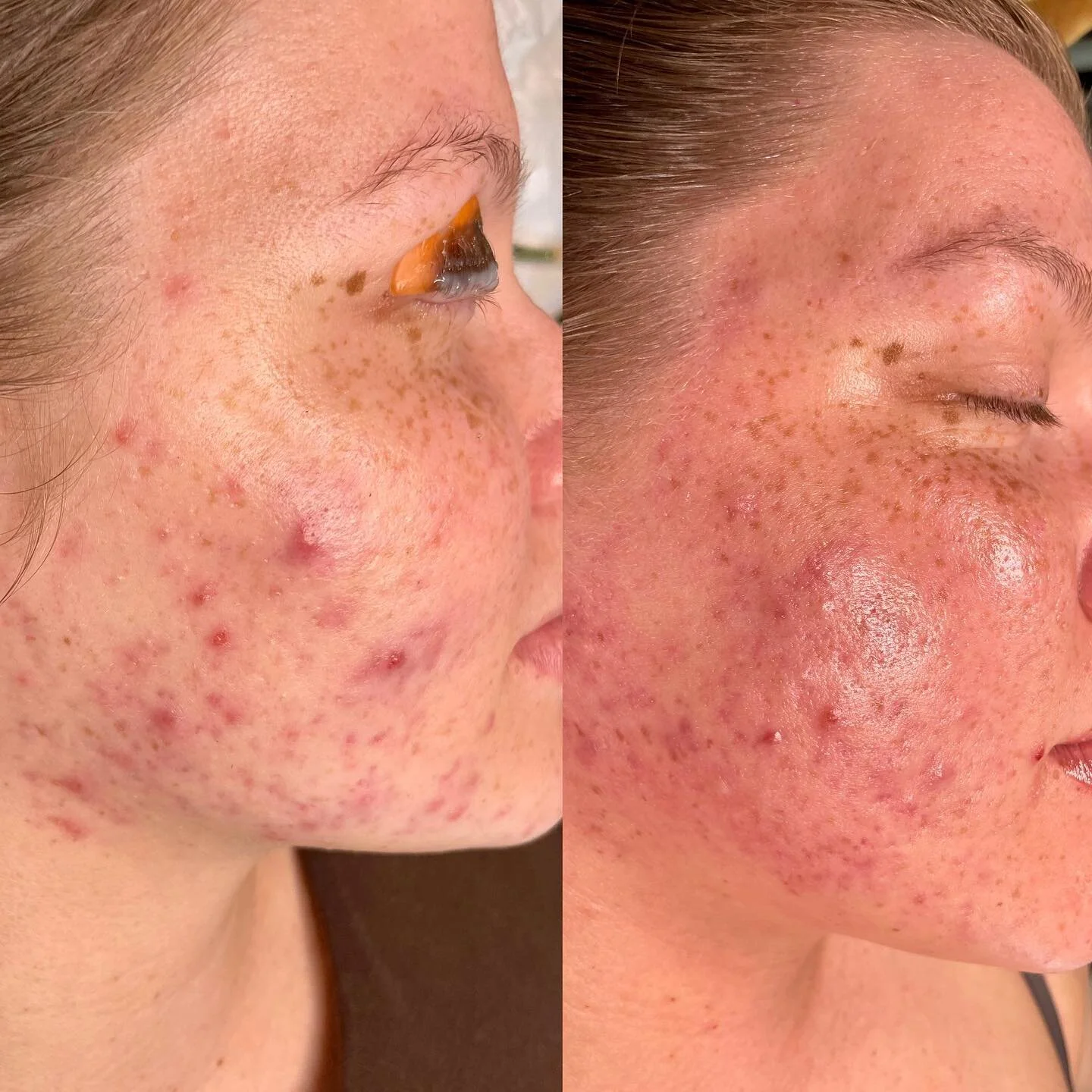 Transformations are why I do what I do. This fuels my soul 🔥

She&rsquo;s a little pinky due to a spicy enzyme but her skin is making MASSIVE changes and we couldn&rsquo;t be happier 🥰

** she&rsquo;s also pregnant so I wasn&rsquo;t able to use a l