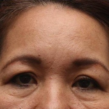 Glabella Filler