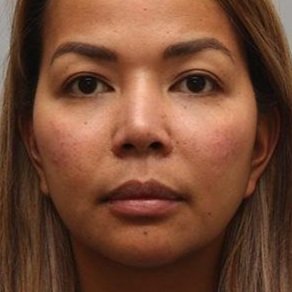 Face (Multiple Fillers)