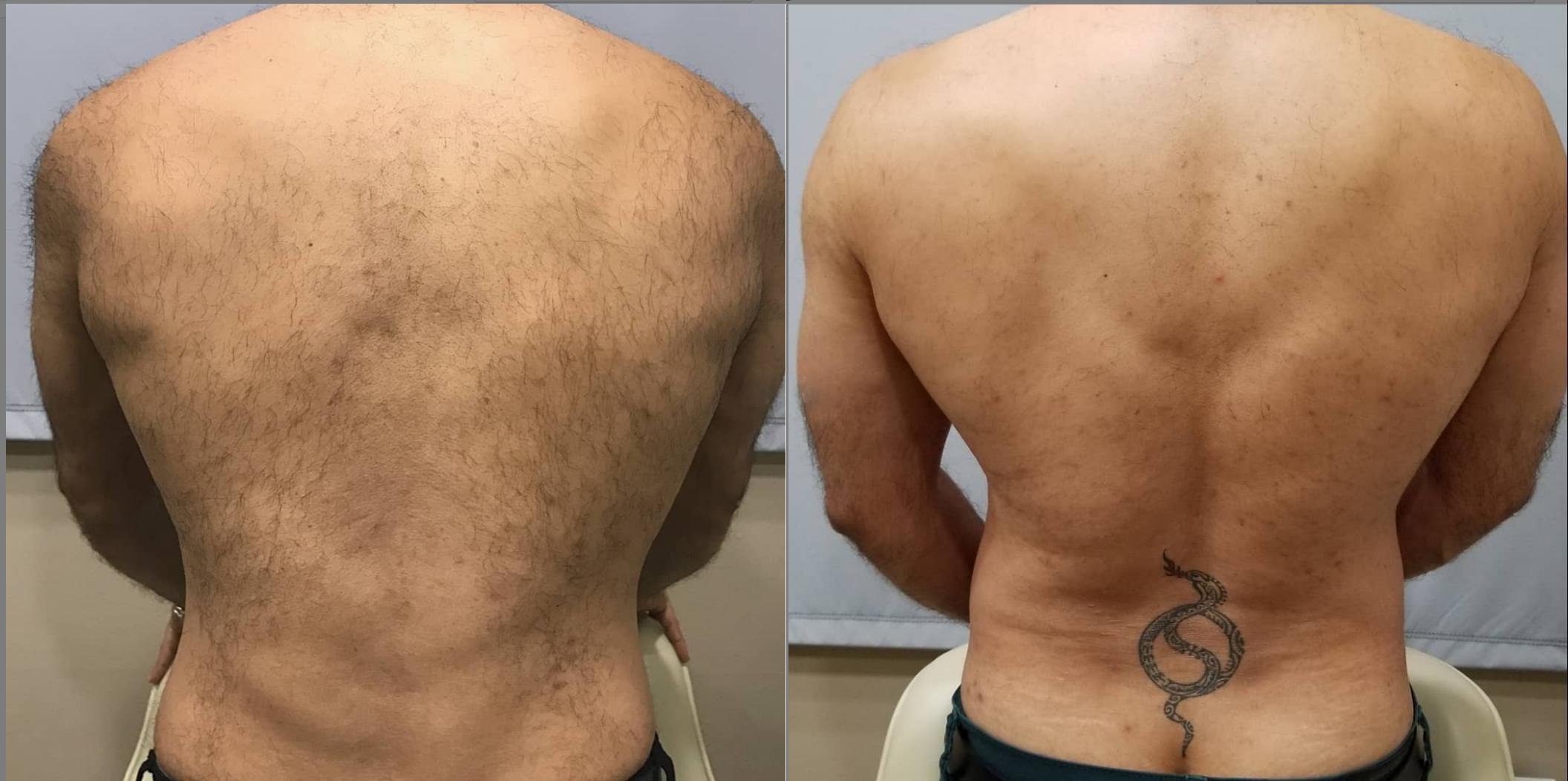 Laser Hair Removal
