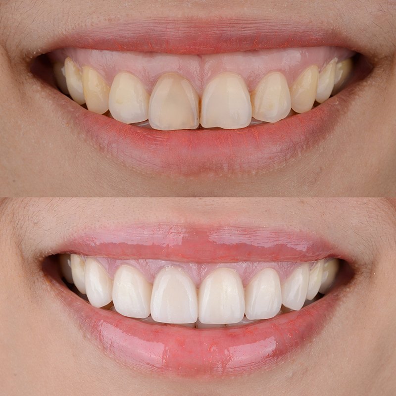 Botox for Gummy Smile