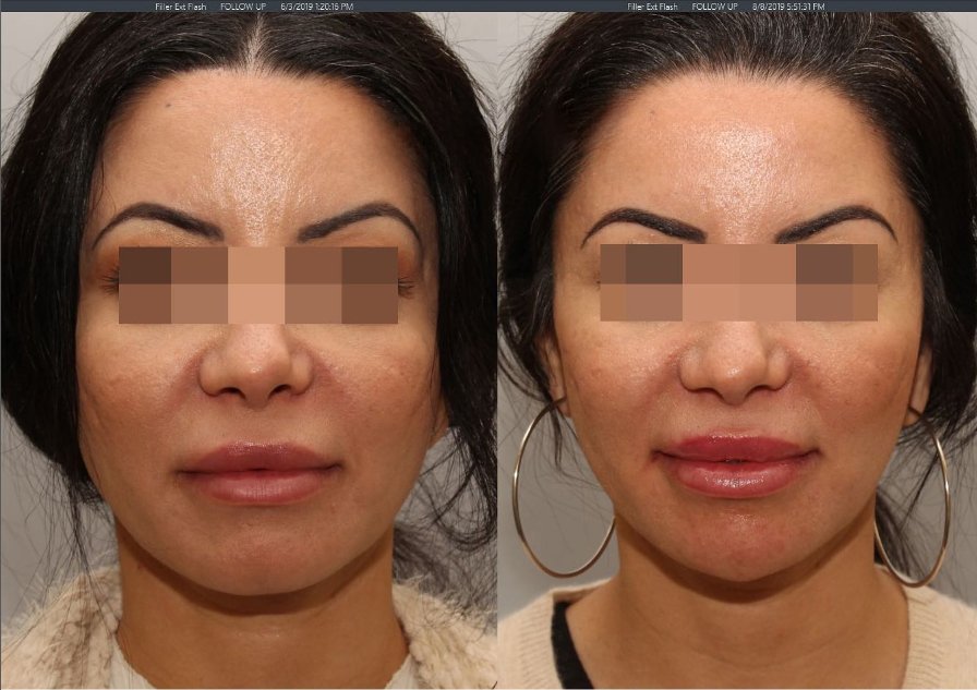 Face shape elongated with chin filler and Botox to masseter muscles. Before and after photos were taken 2 months apart.