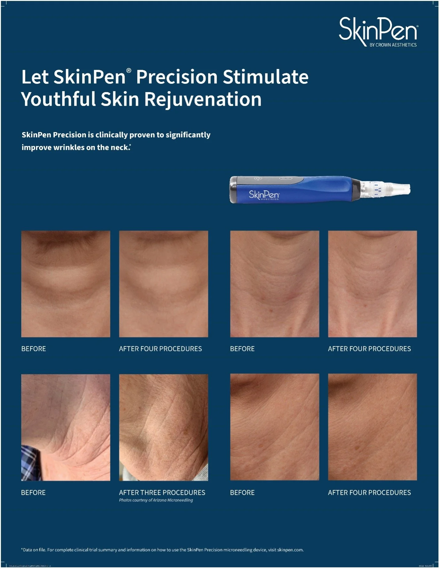 SkinPen® Precision in Torrance, CA — Lumier Medical