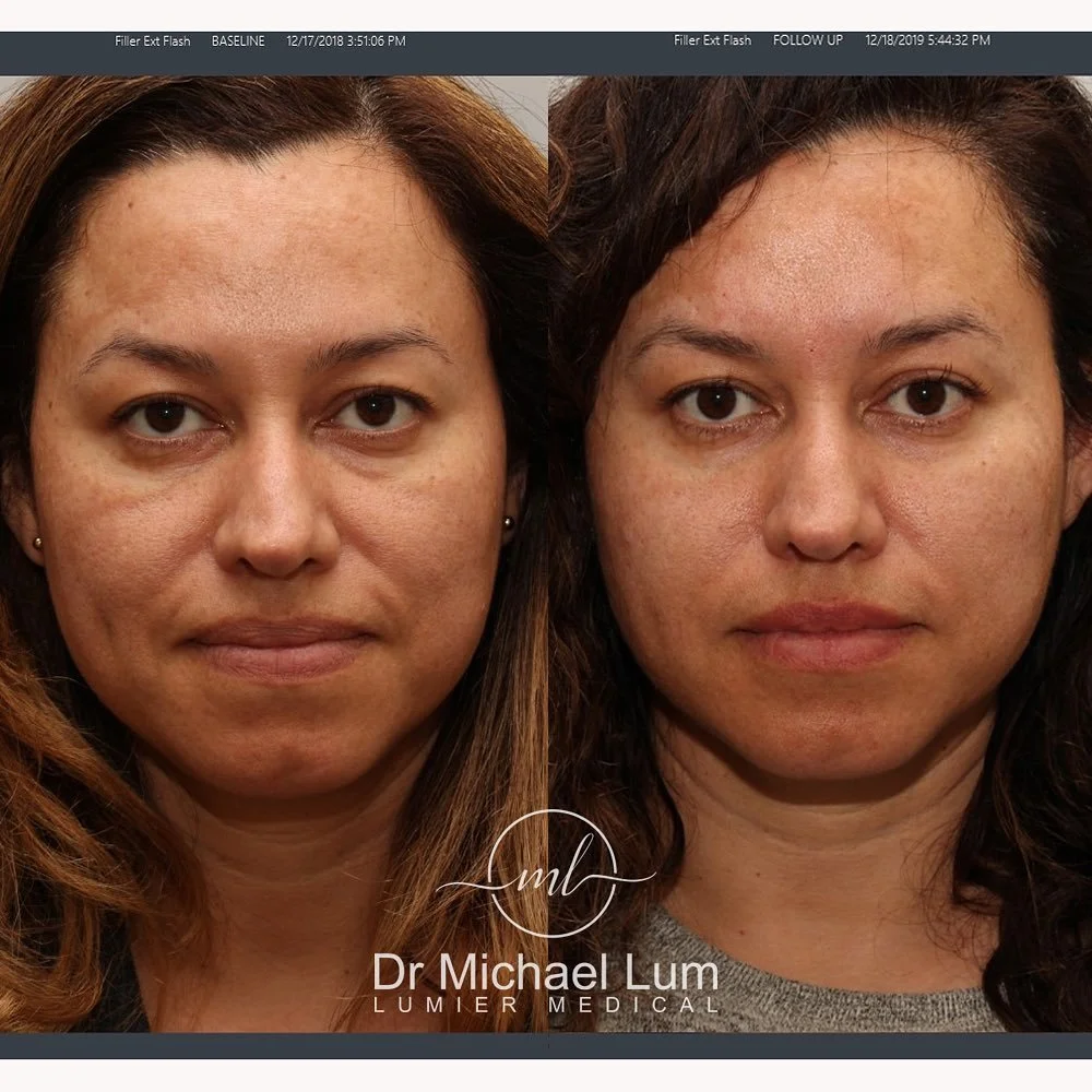 Treating infraorbital hollows begins with augmenting the cheeks. Many patients incorrectly assume that filling the cheeks below the eyes will make the undereye shadows worse.