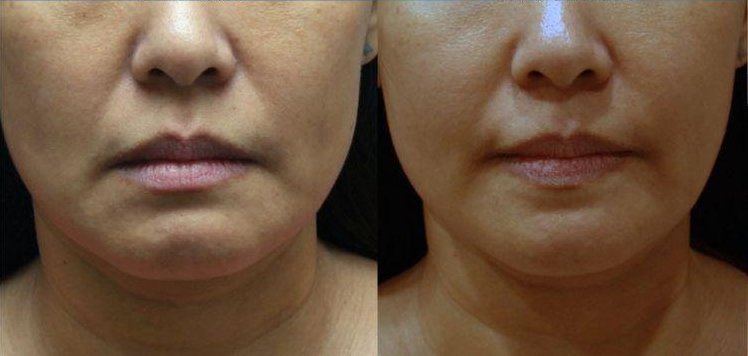 Face appears slightly more slender a few weeks after BOTOX treatment to masseter muscles. Over time and repeat treatments, the lower face will continue to slim down.