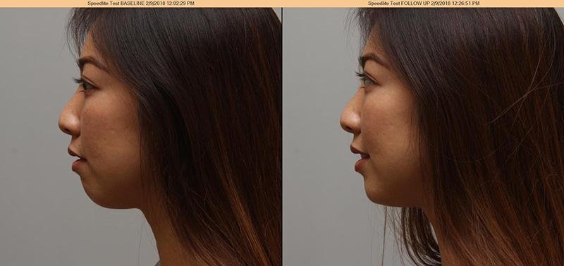 Chin Left.jpeg