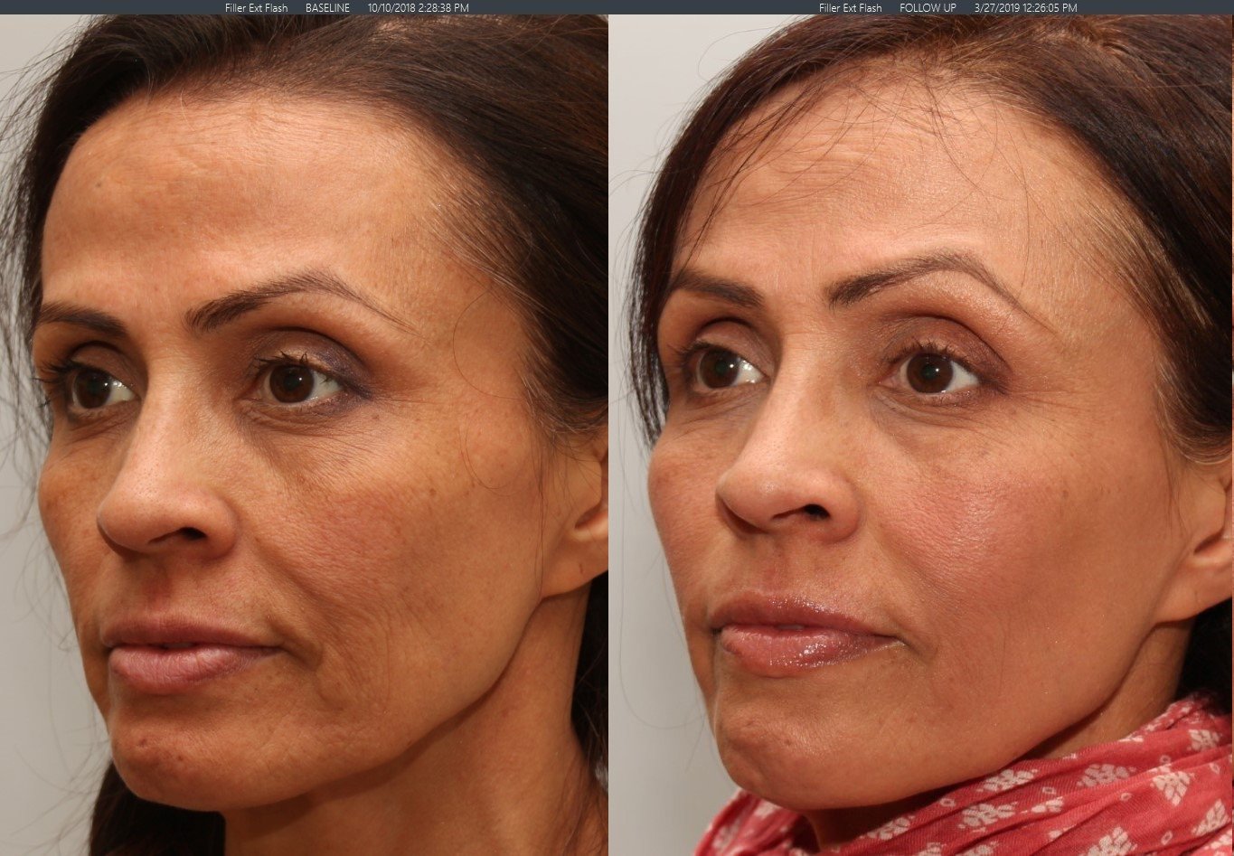 This is an actual patient of Dr. Lum. Before and after photos were taken 5 1/2 months apart after treatments on two separate occasions