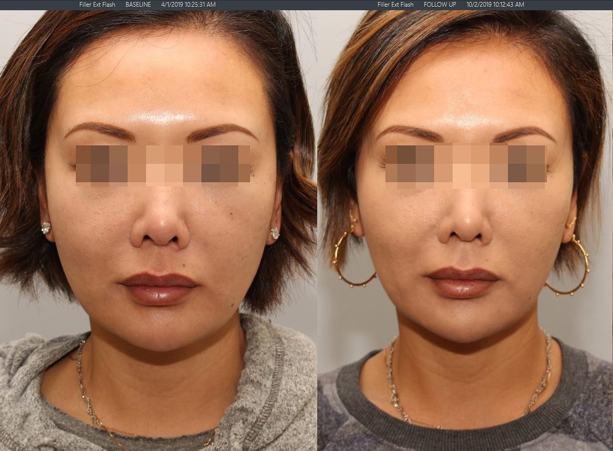 A 46-year-old Asian female was injected with Botox Cosmetic 20 U in each of her masseters. After the photo was taken only 3 months after the first set of injections.