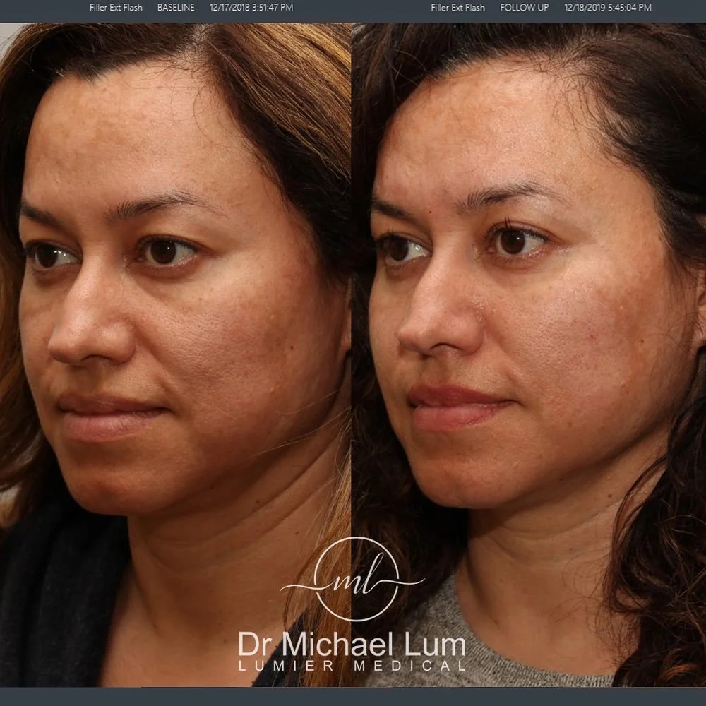 Her inner (anteromedial) cheeks were filled. Notice how the "tear trough" areas improved from just cheek filler.