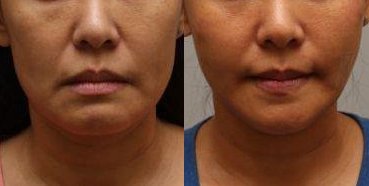 The dramatic change in the lower face shape is from a combination treatment of both BOTOX to the masseter muscles and a PDO thread lift.