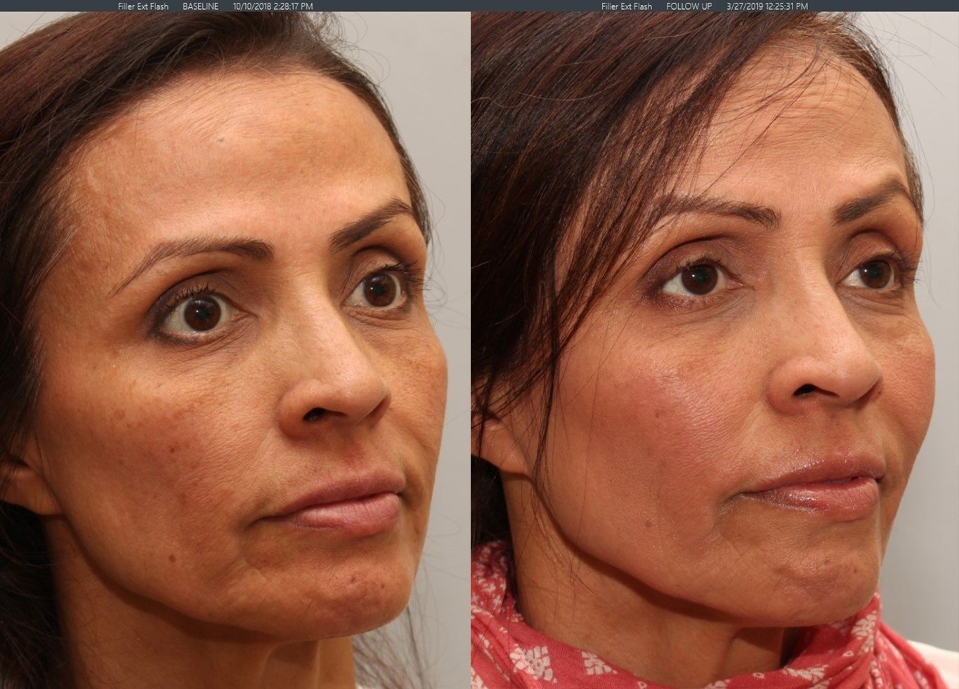 Sculptra3.jpg