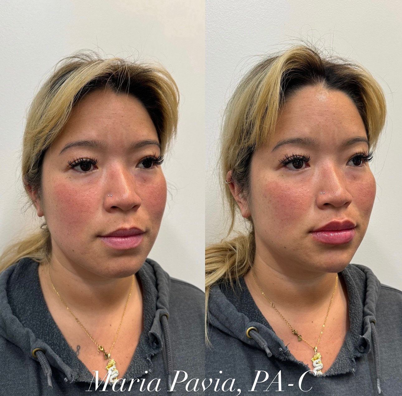An ✨ENHANCEMENT✨ for my BEAUTIFUL patient🩶

We treated the following areas:
🌟 MIDFACE
🌟 MEDIAL &amp; LATERAL CHEEK
🌟 CHIN &amp; CHADOWS
🌟 LIPS 👄
🌟 &amp; BOTOX

📲 Call/Text (248)924-4058 to book

#LipFiller #FacialBalancing #MidFaceFillers #Fi