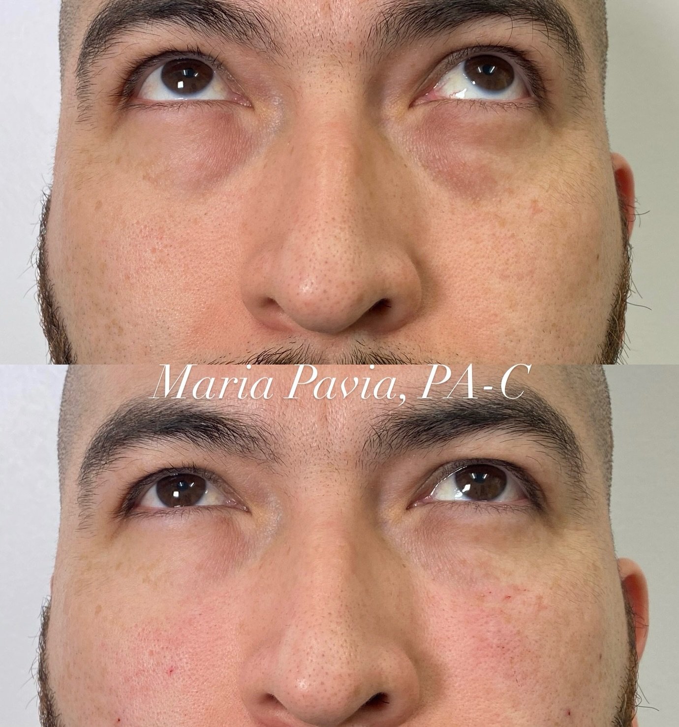 MALE UNDER EYE REJUVENATION💫

Through precise micro-injections of filler in the tear through area, volume was restored to the hollow areas under the eye which resulted in a refreshed and ✨brighter✨ appearance. 

📲 Call/Text (248)924-4058 for more i