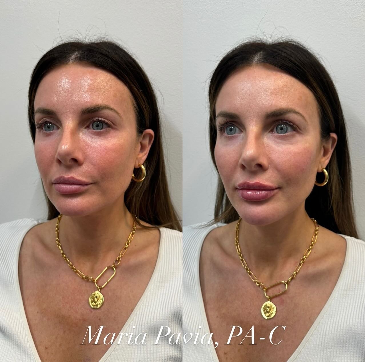 My patient is BEAUTIFUL to begin with

We focused on enhancing✨ the following areas 

✨ MID FACE
✨ CHEEKS
✨ CHIN &amp; CHIN SHADOWS 
✨ LIPS👄

Her results are gorgeous and so natural

#FacialBalancing #CheekFiller #NaturalLip