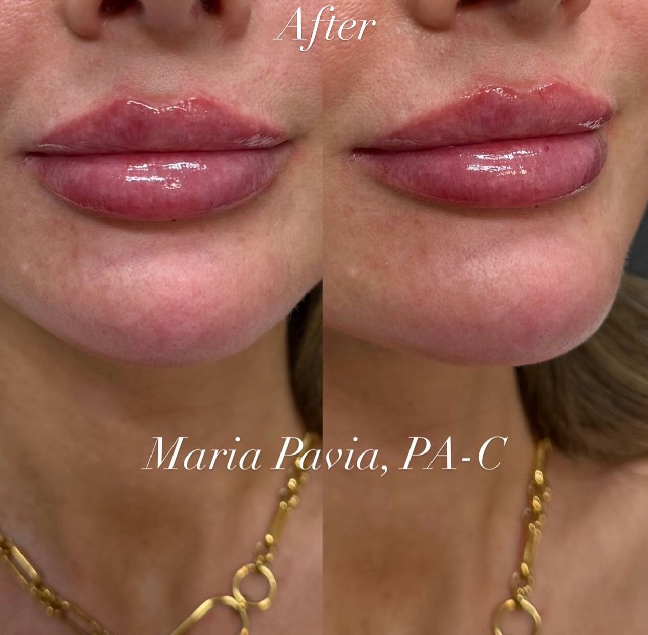 Her results are ✨STUNNING✨

This serves as a perfect illustration of how through precise injections and a specialized technique, fillers can address lip asymmetry👄💉 We enhanced her lips to create fullness, definition, and hydration. We just LOVE he