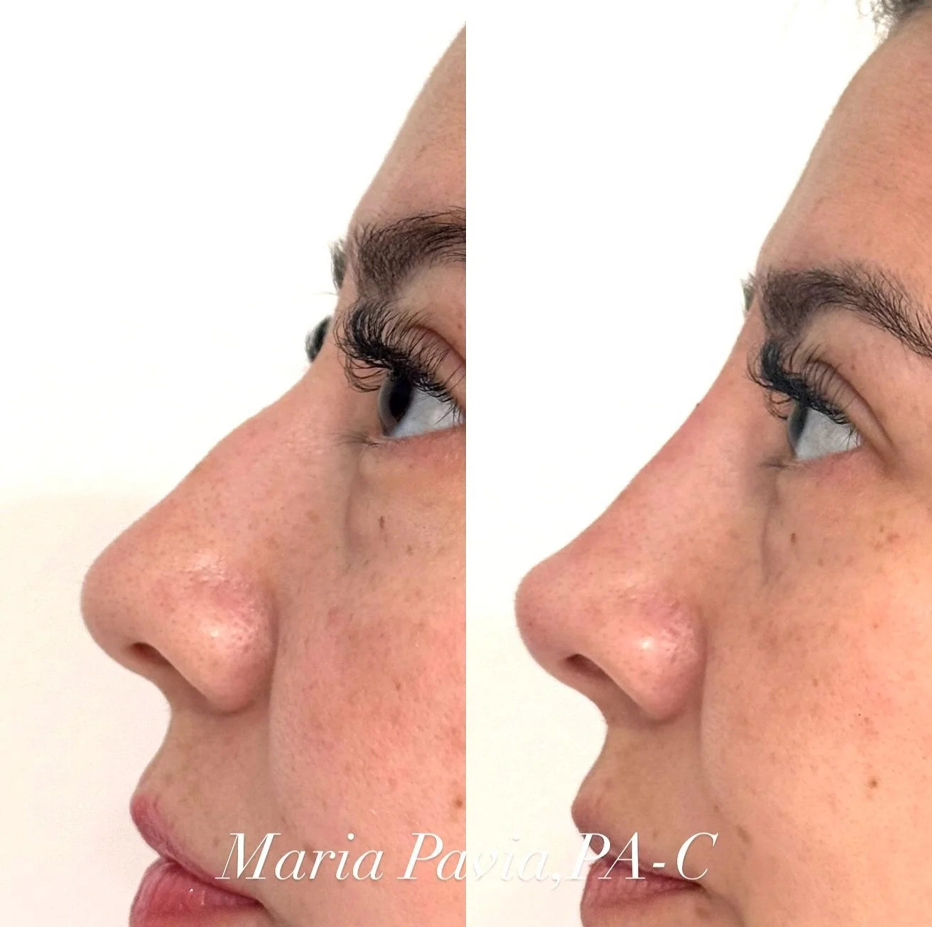 Barbie Nose - a perfectly Lifted Tip and beautifully sculpted Nasal bridge 💫. When I handed her the mirror, she said it went beyond her dream nose. We&rsquo;re obsessed with her elegantly defined profile.