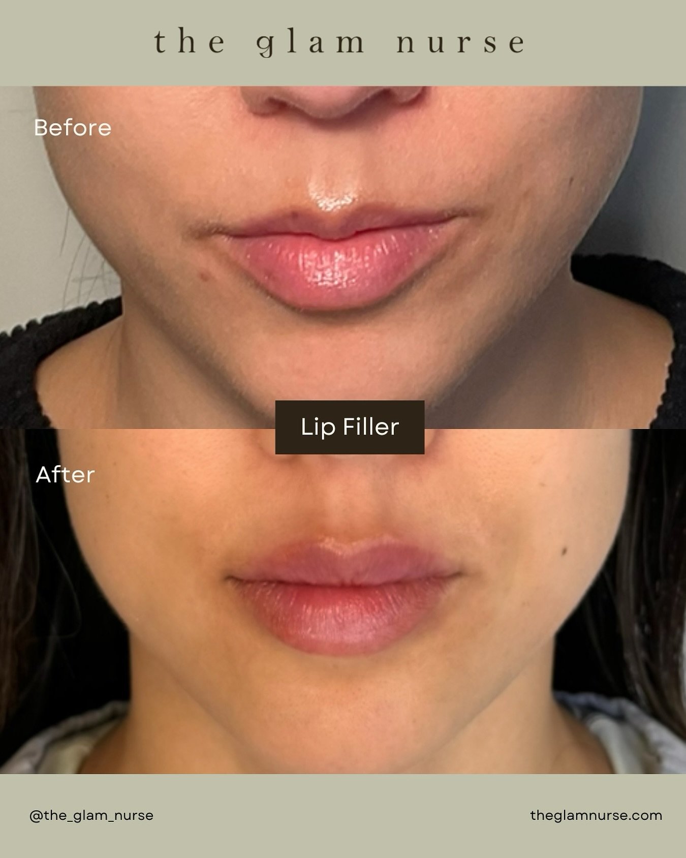 A little M-Shaped Magic!✨
These lips were already beautiful, but a little enhancement brought out their full potential! We kept it soft, natural, and balanced 💉👄

Every lip is unique, and that&rsquo;s why expert technique matters! 🤌🏼

We are curr