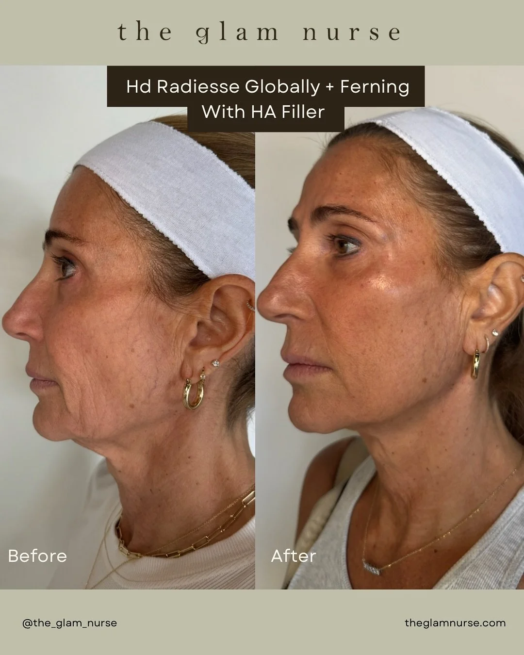 We&rsquo;re big believers in combination treatments, and this beautiful transformation is a perfect example. ✨

Using hyper-dilute Radiesse for global collagen stimulation and hyaluronic acid filler with the ferning technique for precise definition, 
