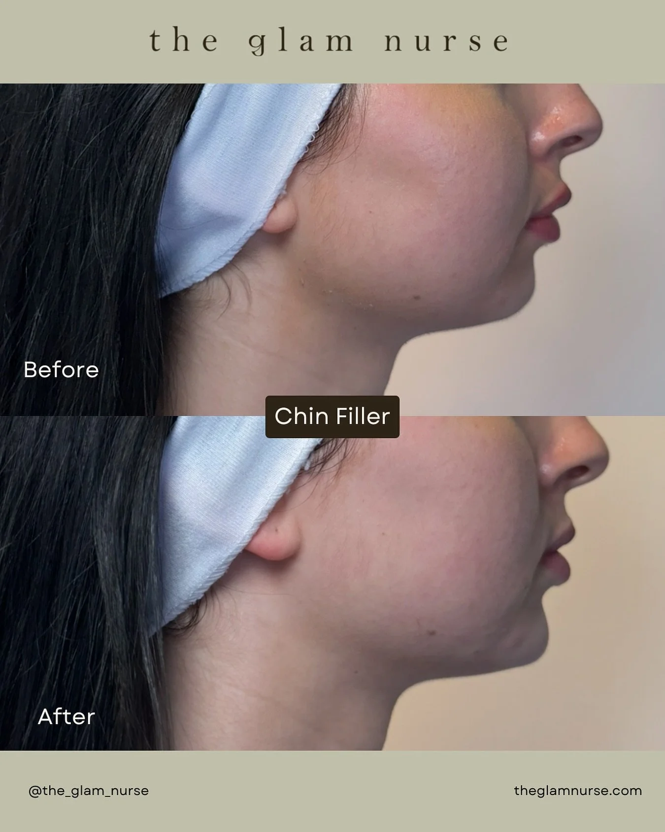 A balanced profile is the foundation of facial harmony. 💫

Chin filler offers subtle structure and definition, bringing balance to the upper two-thirds of the face. 💉

We are currently scheduling into November, so please plan your appointments ahea