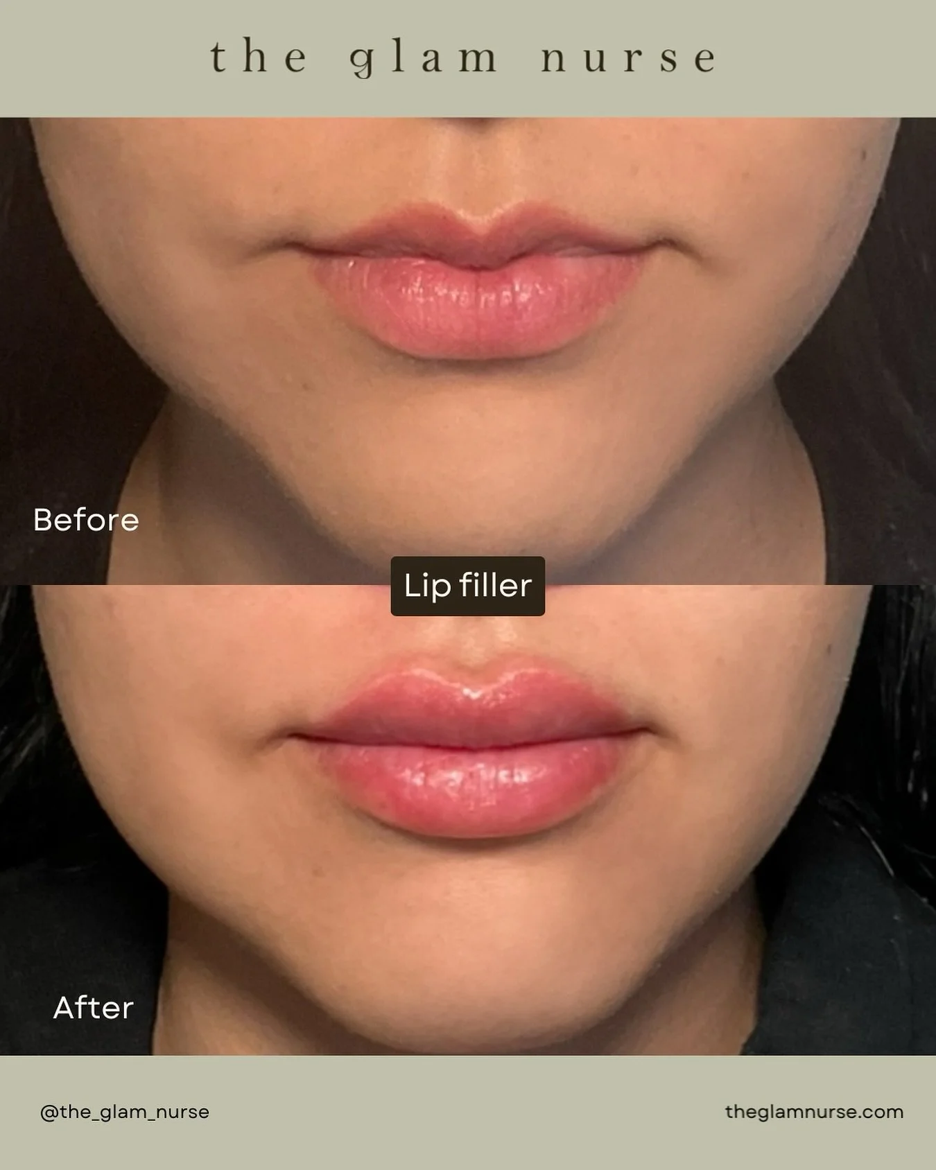 Balancing an M-shaped lip isn&rsquo;t about changing your lips, it&rsquo;s about enhancing what&rsquo;s already there.👄⚖️

With strategic placement and subtle artistry, we softened the peaks, restored volume, and created a smoother, more defined sha