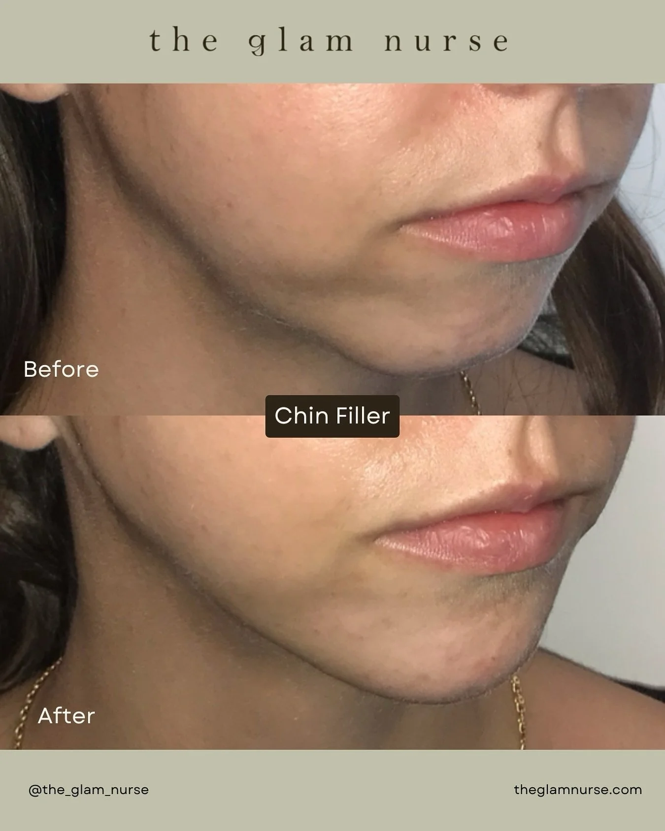 💫Chin filler is one of the most underrated treatments! It lengthens the profile, sharpens the jawline, and brings natural harmony to the face. And this is just her first treatment&hellip; look at that improvement. ✨

We are currently scheduling into