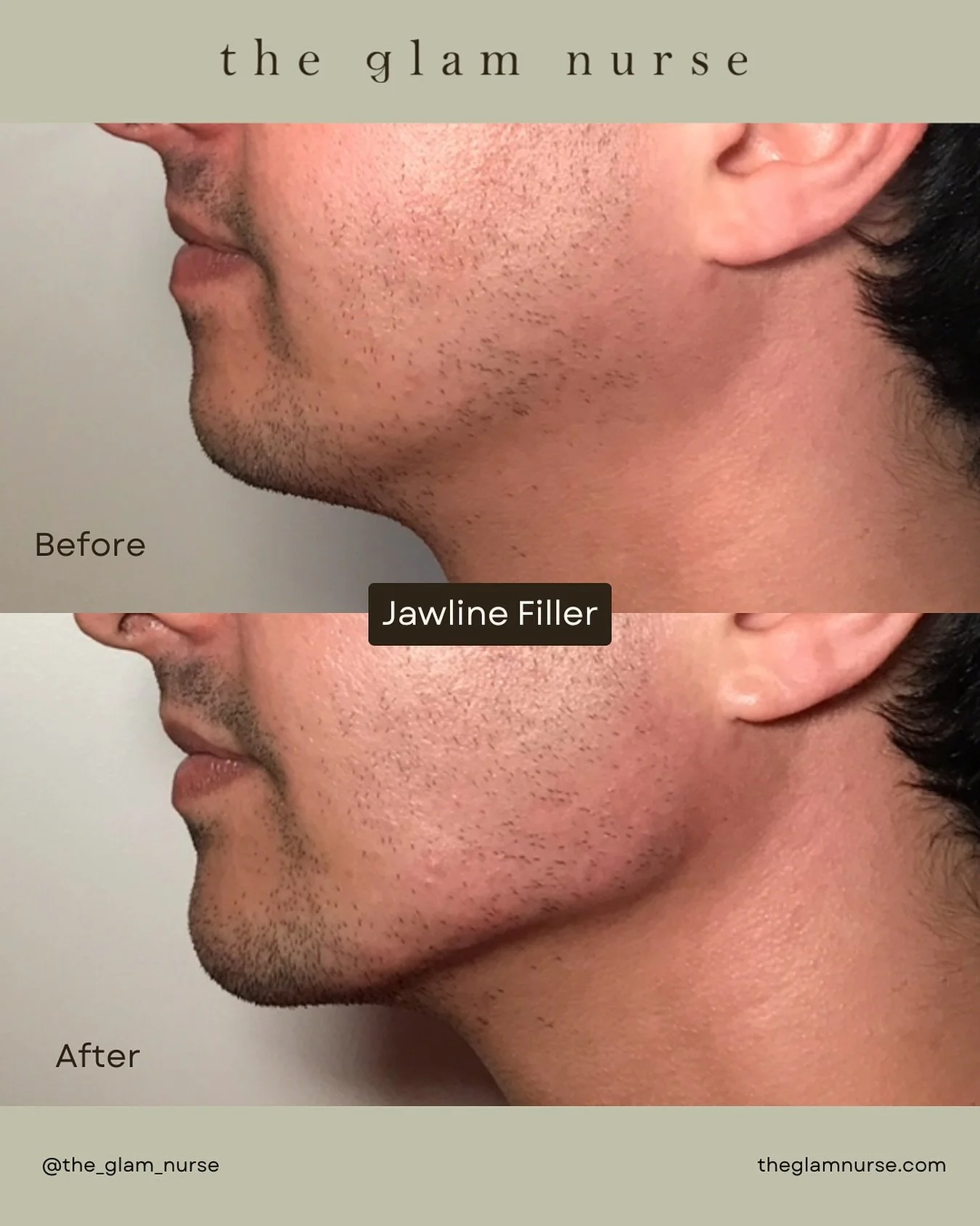 Men need love too 💉Jawline filler is one of the most underrated treatments for a clean, structured, masculine look. 📐 

We are currently scheduling into December, so please plan your appointments ahead😉

Please note swelling, bruising and slight u