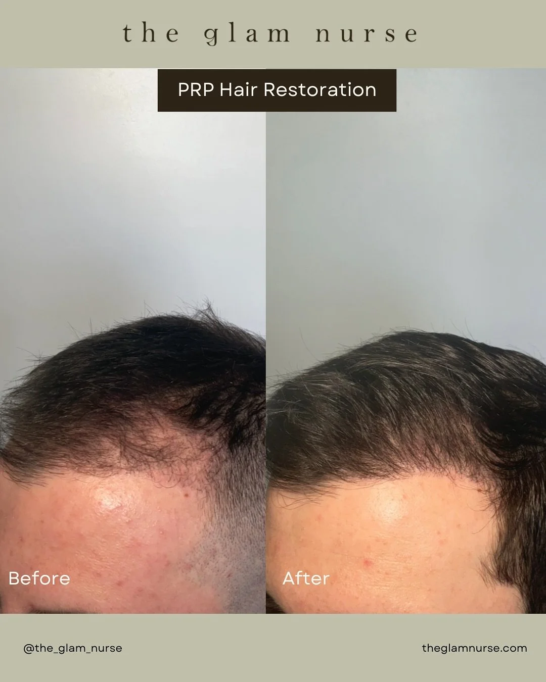 PRP Hair Restoration for the WIN (Men&rsquo;s Edition)! 💪✨
Can we take a moment for these results?! 👀🔥

Hair thinning doesn&rsquo;t just affect women, so many men experience shedding, receding, or loss of density, and it can take a real hit on you