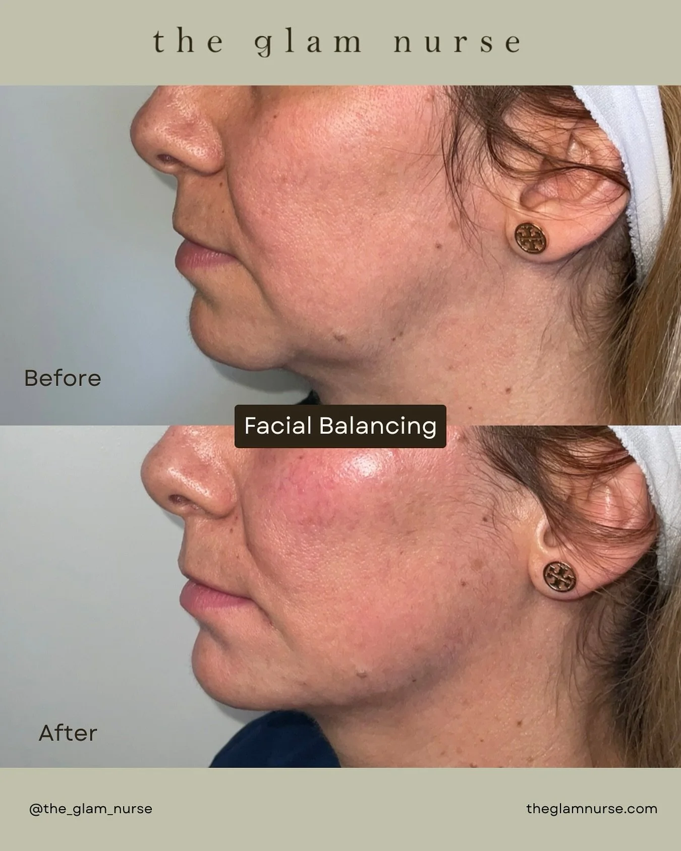 Before &amp; After facial balancing focused on structural support ✨ Using Radiesse and filler to restore foundation, improve proportions, and enhance natural harmony without changing what makes this face unique. 💉

Schedule a consultation through th